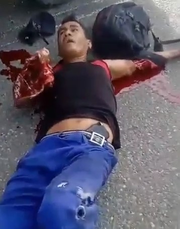 victim with arms destroyed in accident