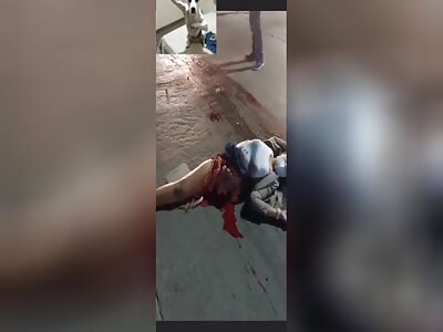 Woman's leg severed in horrific accident