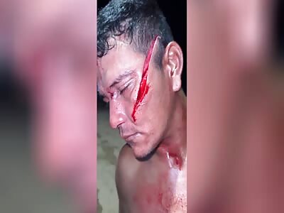 Face cutted with machete 