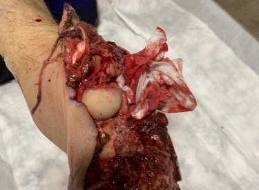 Russian wounded soldier get his leg amputed 