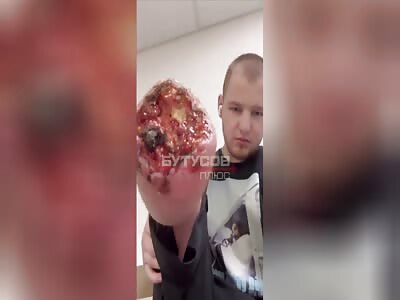 When Stepping on a Anti-Personnel Mine