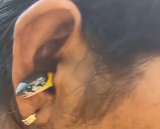 Snake Being Removed from a Woman's Ear