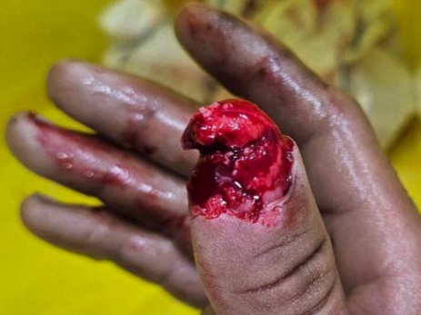 finger injuries and fractures by a Bicycle chain