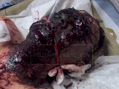 Soldier Victim of Landmine Explosion Hospitalized 