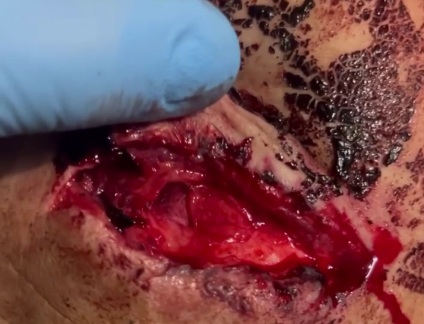 Wounded Russian soldier hospitalized 