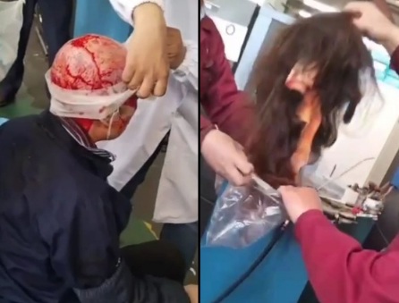 Chinese woman scalped after her long hair was caught in machine 