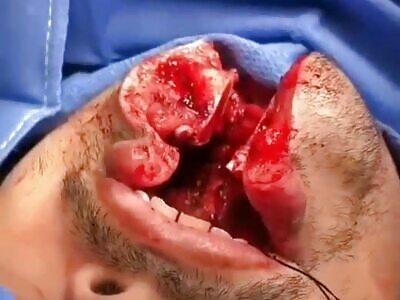 Victime of motorcycle accident hospitalized 