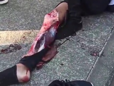 Young student leg crashed and skinned under school bus tire 