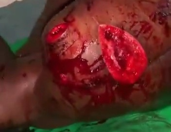 Victime of a machete attack hospitalized 