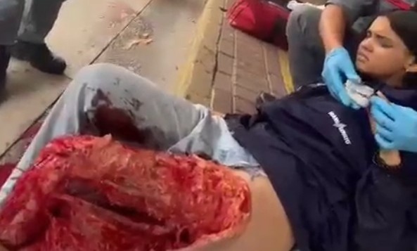 Girl Suffers Horrific Leg Injury