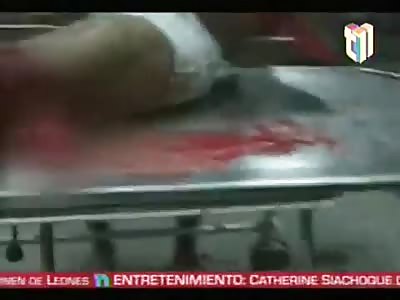 He lost his left leg in accident