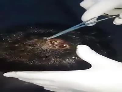 Boy with a Maggot Infection Inside of His Head