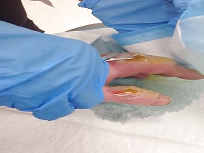 Second degree burns on hand
