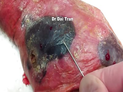 blister after freezing with liquid nitrogen