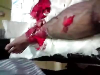 Ankle damage during bike accident