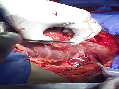 Extraction of a 9 mm caliber bullet embedded in the heart.