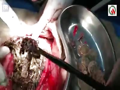 Doctors remove 3lbs of coins and jewellery from compulsive eaterstomac
