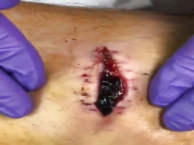 Evacuation of a large hematoma of the leg!!