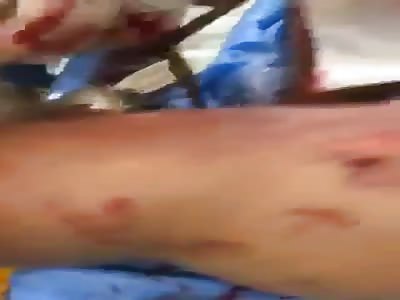 Extracting gas bomb stuck in hand of Iraqi protester