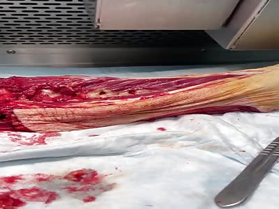 Amputated leg still twitching hours later