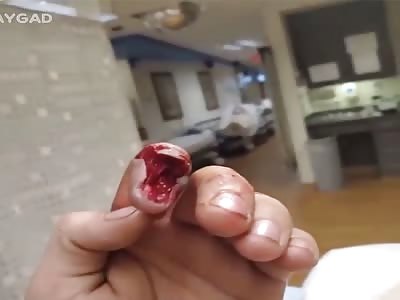 Finger tips after brutal work accident 