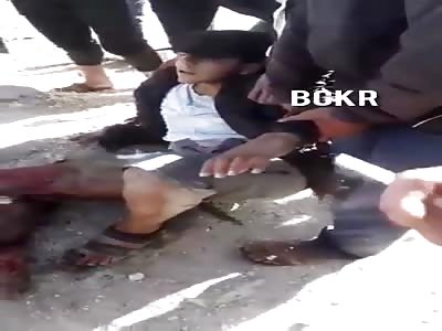 Man with shattered leg after accident.