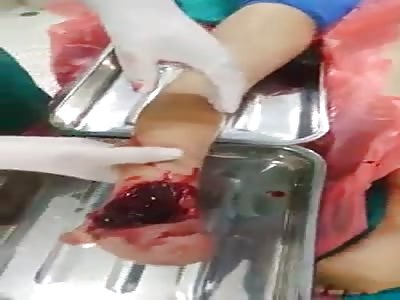 Little boy have horrific leg injury hospitalized 