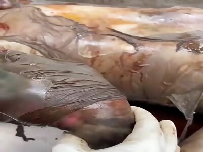 Removing hand skin from rotten dead body 