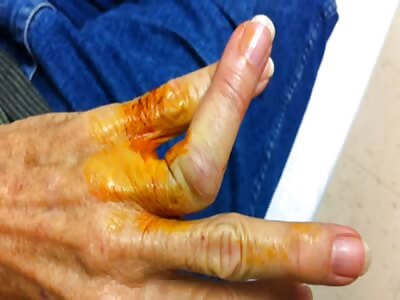 Repairing broken finger 