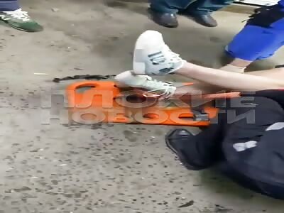 Horrific leg injury due to road accident 