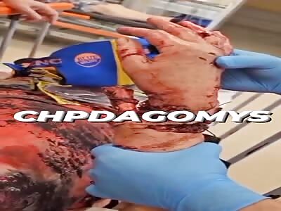 stray dogs attacked a woman who decided to feed them