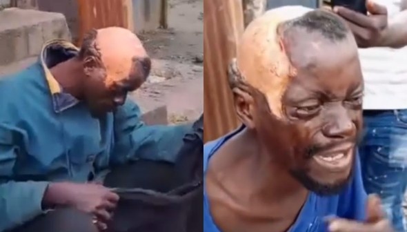 Man Scalped Following Acid Attack