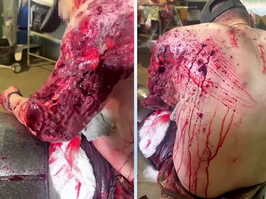 Russian's Really Nasty, Gory Shrapnel Wound