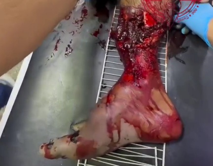 Old man leg horrifically crashed due to motorcycle crash 