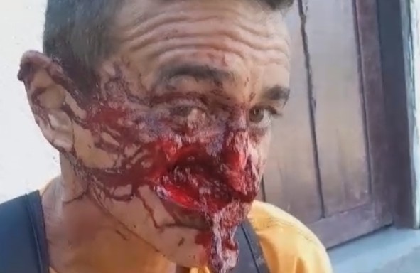 Man`s Face Destroyed After Motorcycle Accident