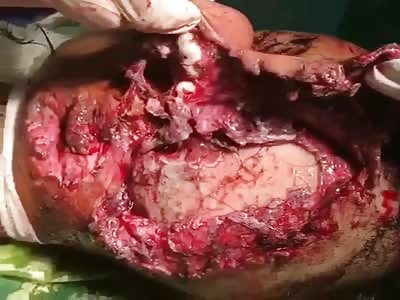 8-year-old boy after rollover accident suffers scalp ear and face