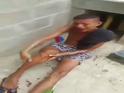 ACCIDENT LEAVES THE ROTE LEG