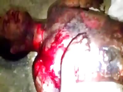 Man suffers burns all over his body