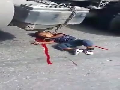 Accident leaves the leg completely shattered