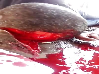 Young Man Partially Scalped in Motorcycle Crash