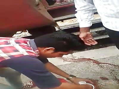 Leg Amputated by Failed Train Hopping