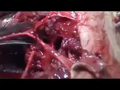 Reconstruction of a leg after accident