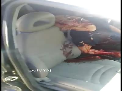 Eye Pops In and Out Socket, Unison with Agonal Breathing