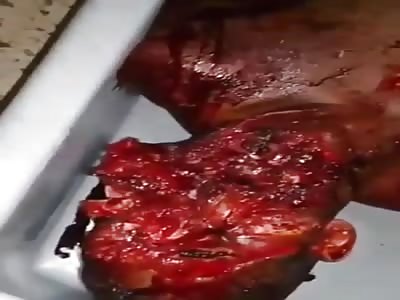 Unrecognizable Facial Features After Savagely Machete Attack.