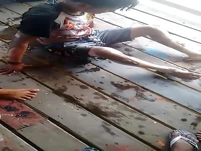 Man with multiple burns after explosion