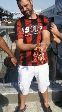  Fire Explosion Destroys Man's Hand