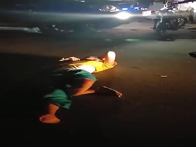 Accident man with shattered leg