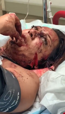 Machete Attacks Make it Hard to Talk