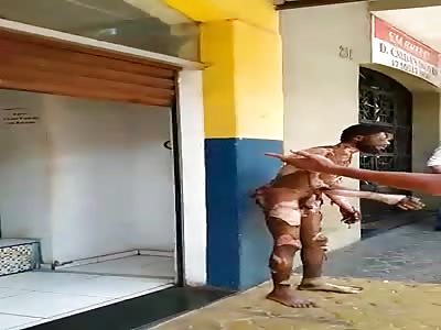 shocking man with whole body burned 