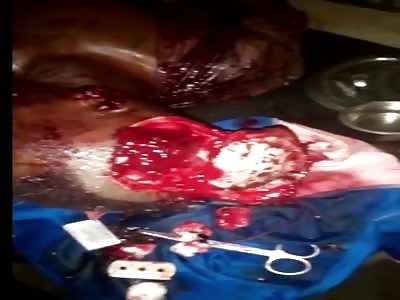 Full GORE  with large cuts after being attacked with a machete